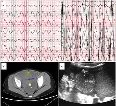 Successful Use of Extracorporeal Life Support and Continuous Renal Replacement Therapy in the Treatment of Cardiogenic Shock Induced by Tumor Lysis Syndrome in a Pediatric Patient With Lymphoma: A Case Report